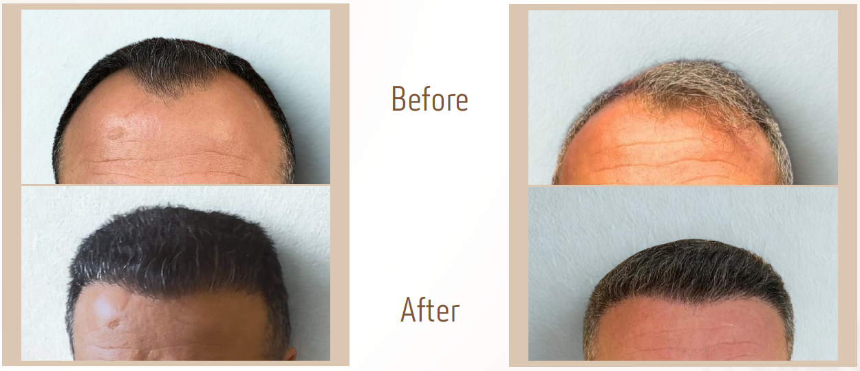 2زراعة-شعر1
