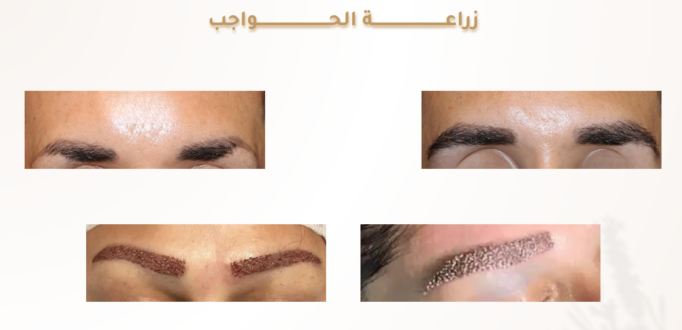 زراعة-الحواجب