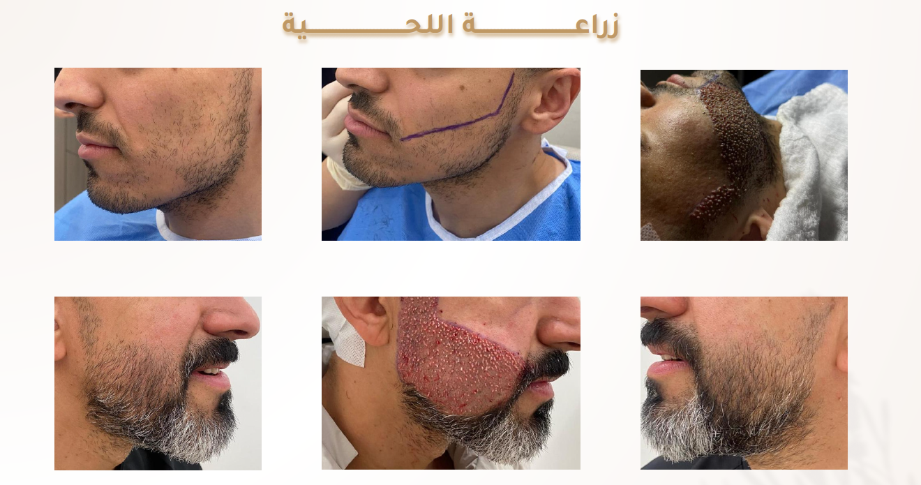 زراعة-اللحية