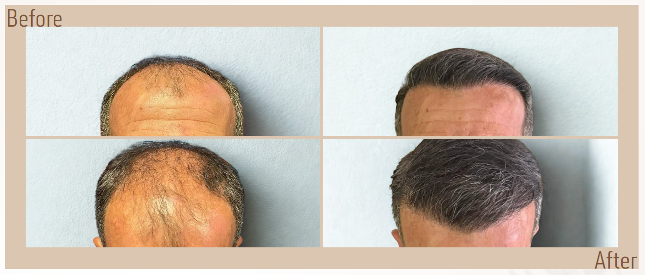 زراعة-شعر1