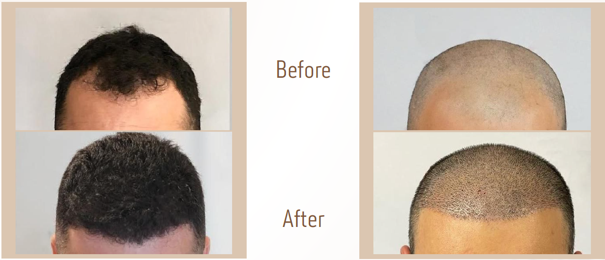 زراعة-شعر3